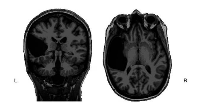 Tomografía del cerebro de la paciente.
Autor: Tuckute y cols