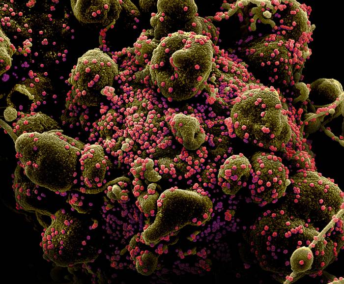 Célula apoptótica -es decir, dispuesta a destruirse- fuertemente infectada por el virus SARS-CoV-2 (puntos rosados) en microscopía de electrones coloreada.
Foto: NIAID