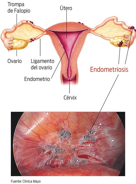Endometriosis Endometriosis