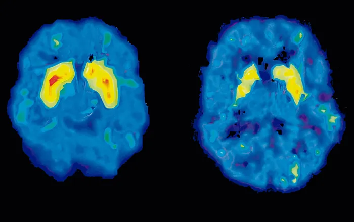 Deterioro cerebral en un usuario de metanfetamina (derecha) frente a un cerebro sin consumo (izquierda). · Foto: NIH-NIAID / AFP