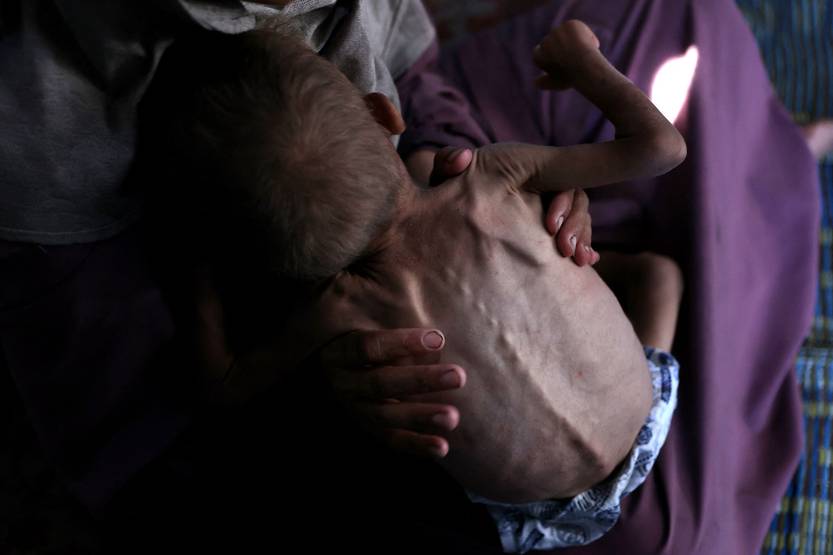 gaza ConflictMalnutrition
