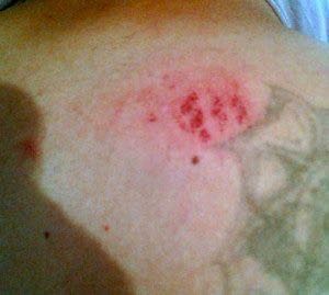 Espalda del policía agredido. Foto cortesía de César Rodríguez, dirigente de SUTAA. 