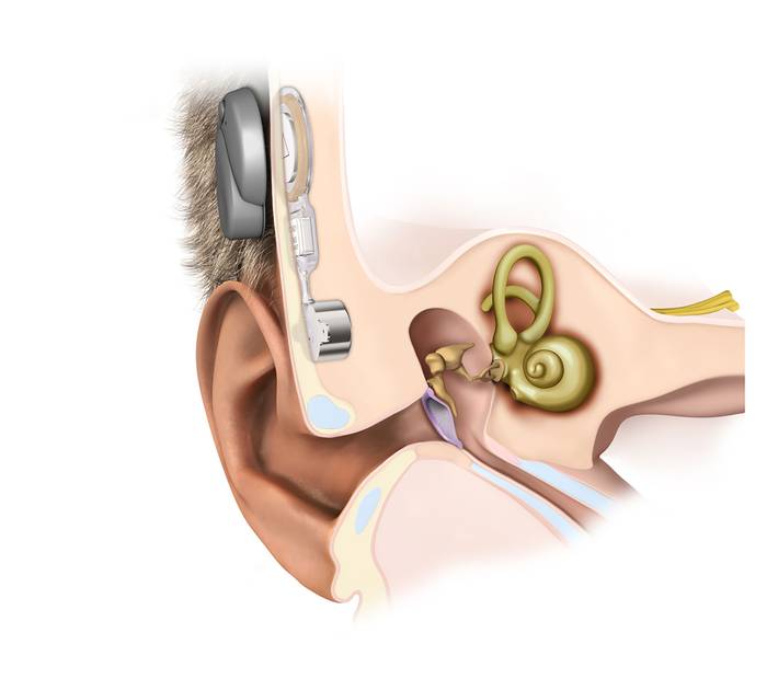 Foto principal del artículo 'Se hizo en Uruguay la primera operación de implante bilateral óseo activo para mejorar la audición'