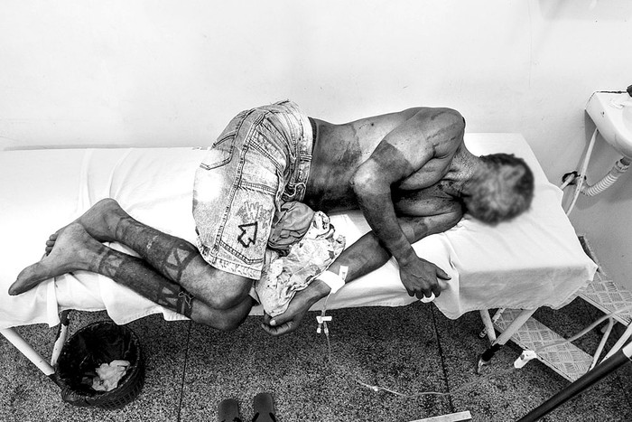 El indígena Gamela Francisco da Luz, víctima de un ataque de agricultores, tras recibir atención médica en un hospital de Viana, estado de Maranhão, al norte de Brasil. Foto:  Ana Mendes, Consejo Indigenista Misionero, AFP