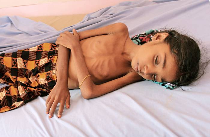 Niño yemení en un centro de tratamiento en un hospital de la provincia de Hajjah, noroeste de Yemen (archivo, octubre de 2018).
 · Foto: Essa Ahmed